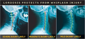 
                  
                    Whiplash 1.0 CEs
                  
                