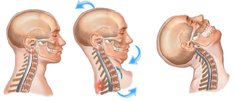 
                  
                    Whiplash 1.0 CEs
                  
                